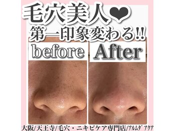 アルムダアクア 天王寺店(Aleumda AQUA)/毛穴エクストラクションプロ