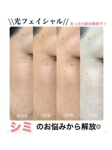 ココネイル 板山店(coco nail)/人気No.1連射式＊光フェイシャル