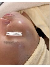 トータルビューティー ココ(Total Beauty CoCo)/【毛穴改善】黒ずみ毛穴ケア