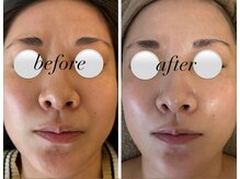 ミエル(miel)/ハーブピーリング直後のお肌