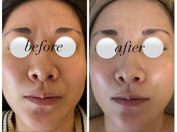 ミエル(miel)/ハーブピーリング直後のお肌