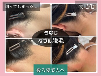 コネクトの写真/暑い季節アップスタイルにする機会も増えます！うなじ脱毛で垢抜け後ろ姿美人へ♪脇や顔脱毛も人気で好評