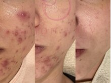 サロンヴェアリー 広尾(salon vary)/ブラックハーブ経過写真