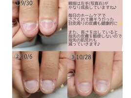 爪周りのささくれ