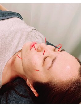 鍼灸院接骨院テトテ(tetote)の写真/プロアスリートの施術実績多数◎本格鍼灸施術を受けたい方に♪『美容鍼/鍼灸をもっと身近に！』