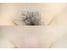 人気No.1☆WAX+光でつるつる長続き♪ VIOダブル脱毛 9,900円→8,900円