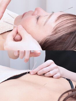 神戸はりのわ鍼灸院の写真/【電気美容鍼×肩こり鍼】お顔と肩こり同時にスッキリしたい方！むくみ/顔こり/食いしばり/頭痛/睡眠の質UP