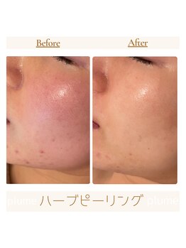 プルーム 久留米店(plume)/ハーブピーリング