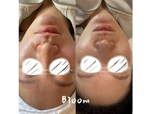 ブルーム(Bloom)の雰囲気（ハーブピーリングで肌質改善★美肌に！）