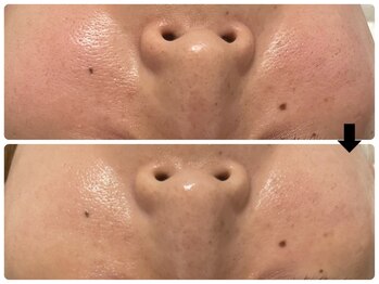 エフェクト 塚口店(effect)/Before After 30代/1回目