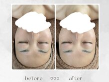 ミコ(MICO)/症例写真