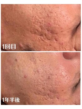 ルタンリッシュオム(Lutan Riche hom)/諦めてたお肌のボコボコも!