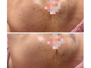 トータルビューティー ココ(Total Beauty CoCo)/【シミケア肌質改善】40代・6回