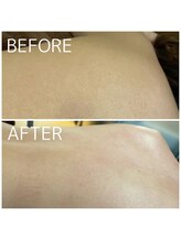 ビューティーサロン アンジュ(Ange)/背中ワックス脱毛