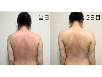 リベル 名古屋(Lebelle:)/ハーブピーリング名古屋リベル