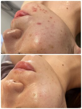 バブルビューティー(Bubble beauty)/肌管理サブスク3ヶ月目☆