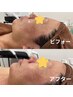 【皮むけなし】国産ハーブピーリング透明感のあるお肌作りで艶ぷる！