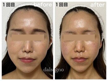 ダルセーニョ/コルギで「圧倒的な変化！」驚！