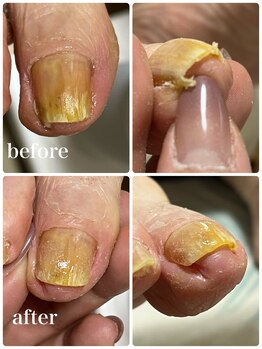 爪屋/痛い巻き爪