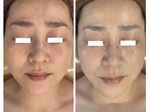 オレアグリーン 岡崎(OLEA green)/小顔矯正1年