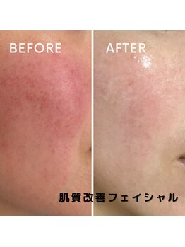 フェイエール鍼灸院 ラスィーヌ(fier鍼灸院 racine)/肌質改善フェイシャル