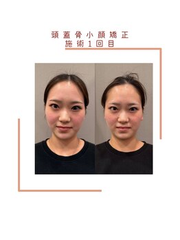 ヴィヴァーチェ(VIVACE)/頭蓋骨小顔矯正ビフォーアフター