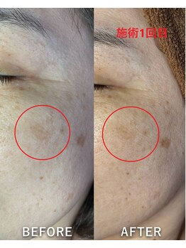 ヒトハダ(hitohada)/50代女性 《》シミケア1回》
