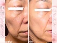 生エクソソームで生まれ変わるお肌冷凍原液100%◎