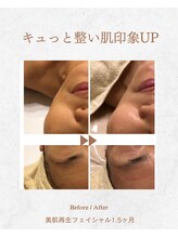 リリアージュ(Lilyage)/キュッと整い肌改善ケア