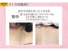 アルゴ 豊中岡町駅前店(ALGO)/【全身脱毛】