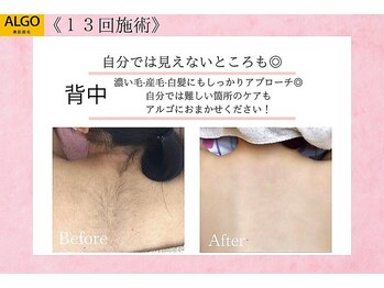 アルゴ 豊中岡町駅前店(ALGO)/【全身脱毛】
