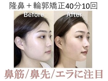 ラプリ 梅田店(Raplit)/隆鼻+輪郭矯正40分10回