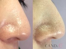キャンディ 難波心斎橋店(CANDi)/ハイドラピーリング/黒ずみ毛穴