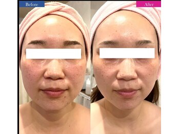 コリオ(KoRiO)/リフトアップ1回［狭山ヶ丘］