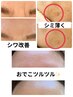 【オプション】電荷ピーリング