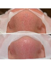 ノーブル 上土店(Noble)/毛穴洗浄BeforeAfter