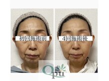 キュープ 富士店(Qpu)/たった4回で若々しい印象へ！