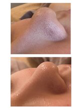 エステサロン マコ(MaCo)/20代・頑固な毛穴黒ずみ改善