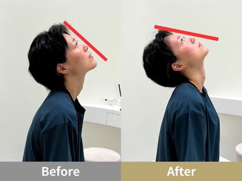 せなかのはね 井尻店/10代　首こり　頭痛　手の痺れ