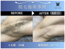 メンズビービー 福井高柳店(MEN'S BB)/ボディ脱毛施術事例