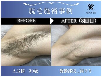 メンズビービー 福井高柳店(MEN'S BB)/ボディ脱毛施術事例