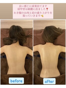 トータルボディケア サニー(TOTAL BODY CARE)/ブライダル・脇の肉を取る