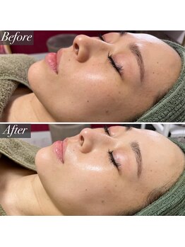 ミロク(MIROKU.)/REVI &nbsp;ハーブピーリング