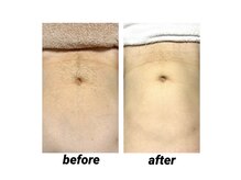 ビカム(become)/メンズ脱毛！