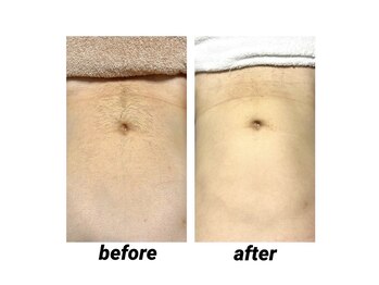 ビカム(become)/メンズ脱毛！