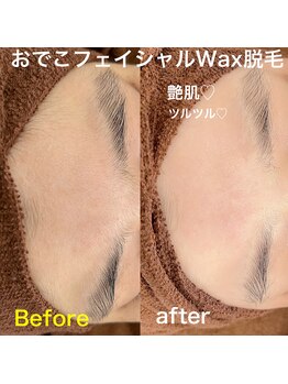 ルミエール(LUMIE’RE)/おでこのフェイシャルWax脱毛