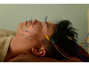 シン(SHINE)/美容鍼灸 頭皮鍼