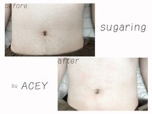 エイシー(ACEY)/ビフォーアフター☆お腹