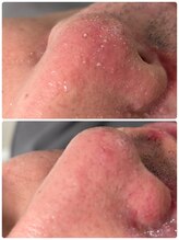 アールセカンド(R.Second)/毛穴洗浄ハイドロ！