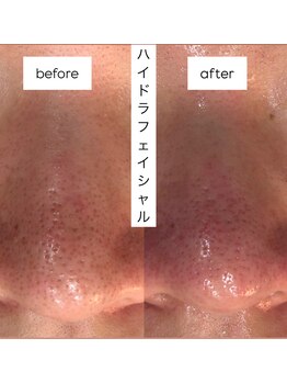 シャルム(CHARME)/【ハイドロフェイシャル】